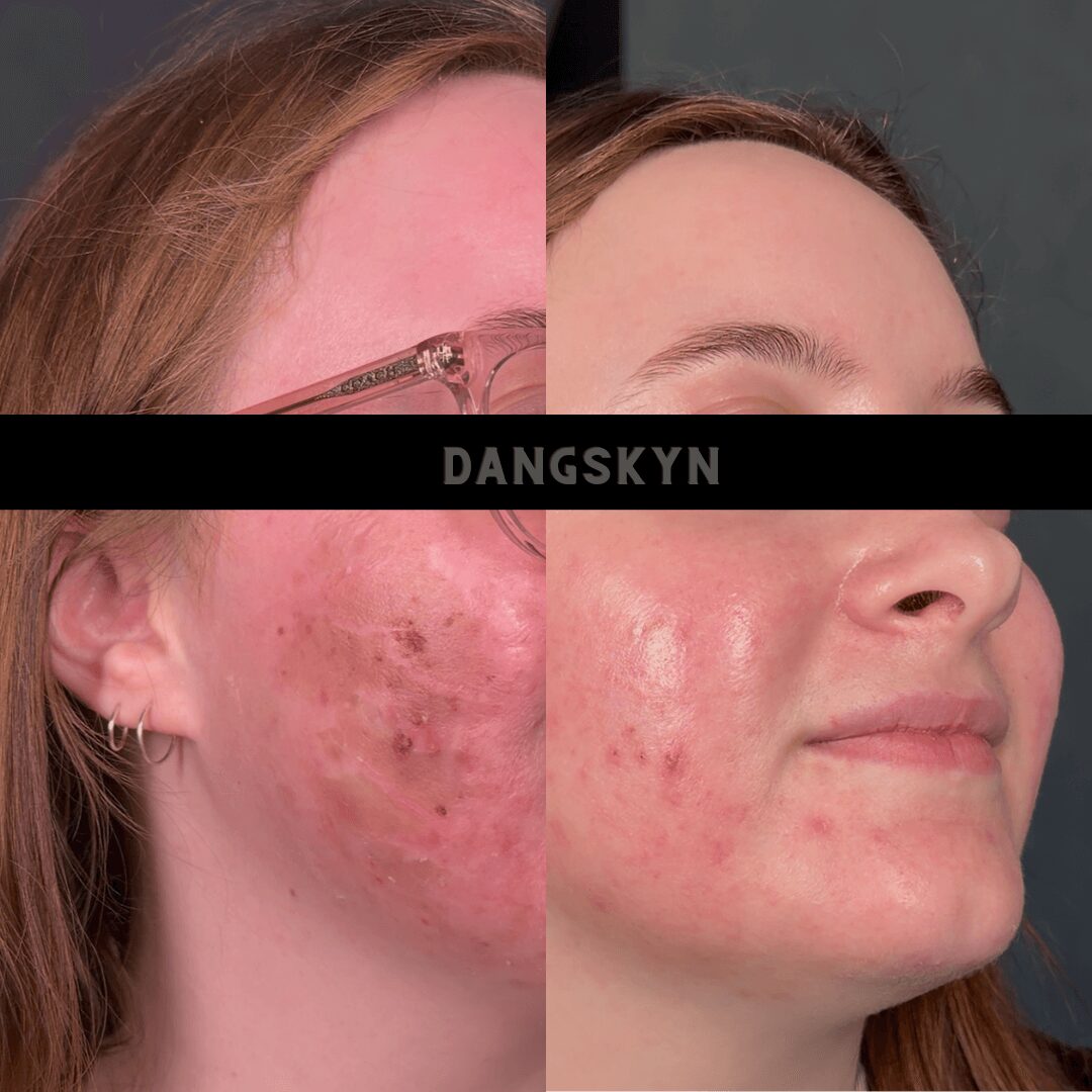 Close-up of a woman's face showing skin with acne scars and redness, with a black bar and text across the middle.