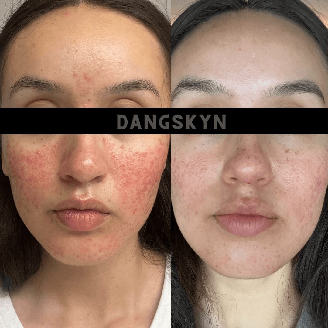 Side-by-side comparison of a woman's face showing skin improvement, with visible acne and redness before and clearer skin after treatment.