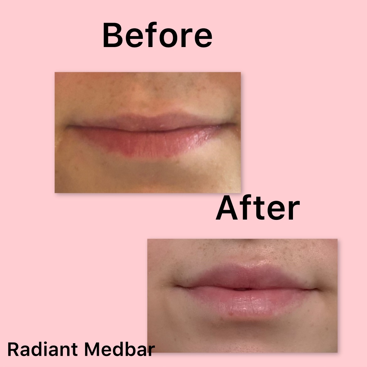 Close-up of lips before and after treatment, showing improvement in lip appearance, on pink background.