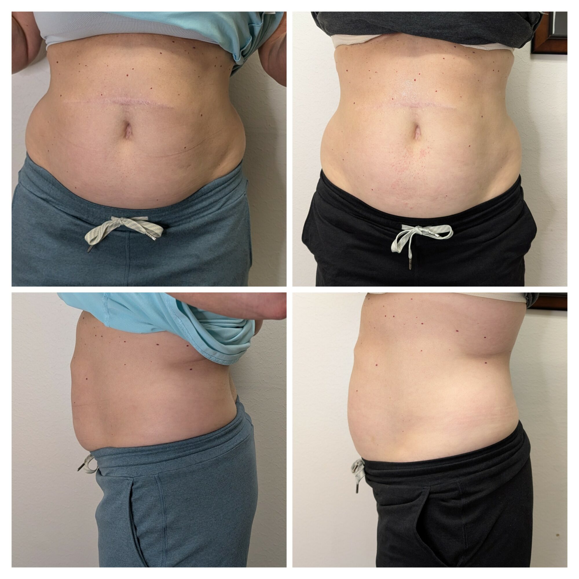 Comparison of abdominal area before and after, showing reduction in size and improved tone, front and side views.
