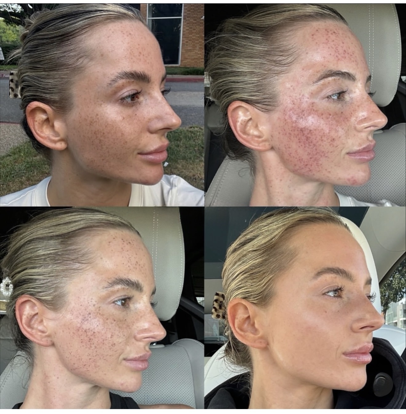 Four images showing a woman's face before and after skincare treatment, highlighting skin improvement and clearing of blemishes.