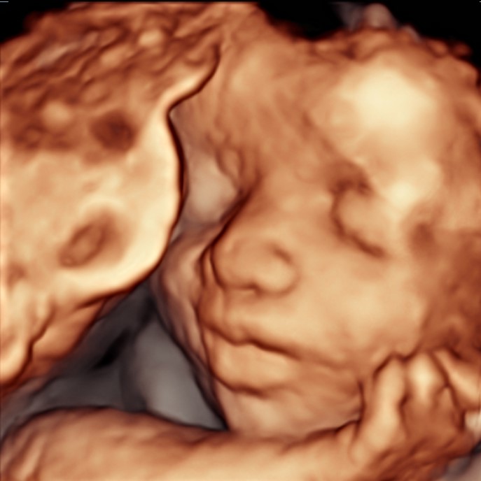 Ultrasound image of a fetus with closed eyes and hand near face, showing detailed facial features.
