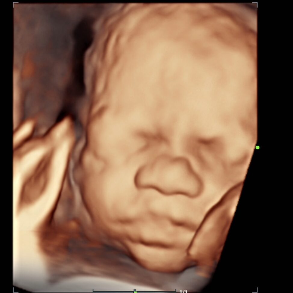 3D ultrasound image of a sleeping baby's face with closed eyes and relaxed features.