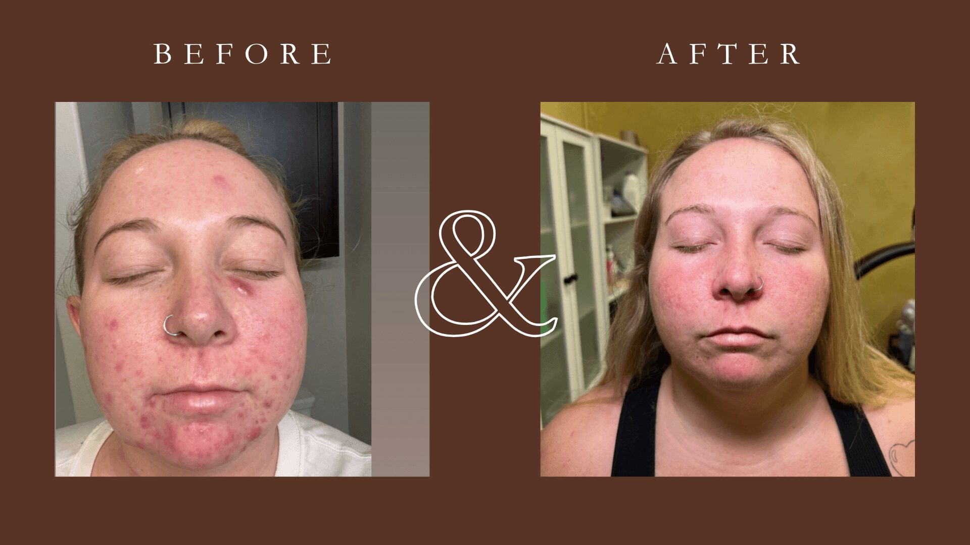 Side-by-side comparison of a woman's face before and after skincare, showing clearer skin in the after image.