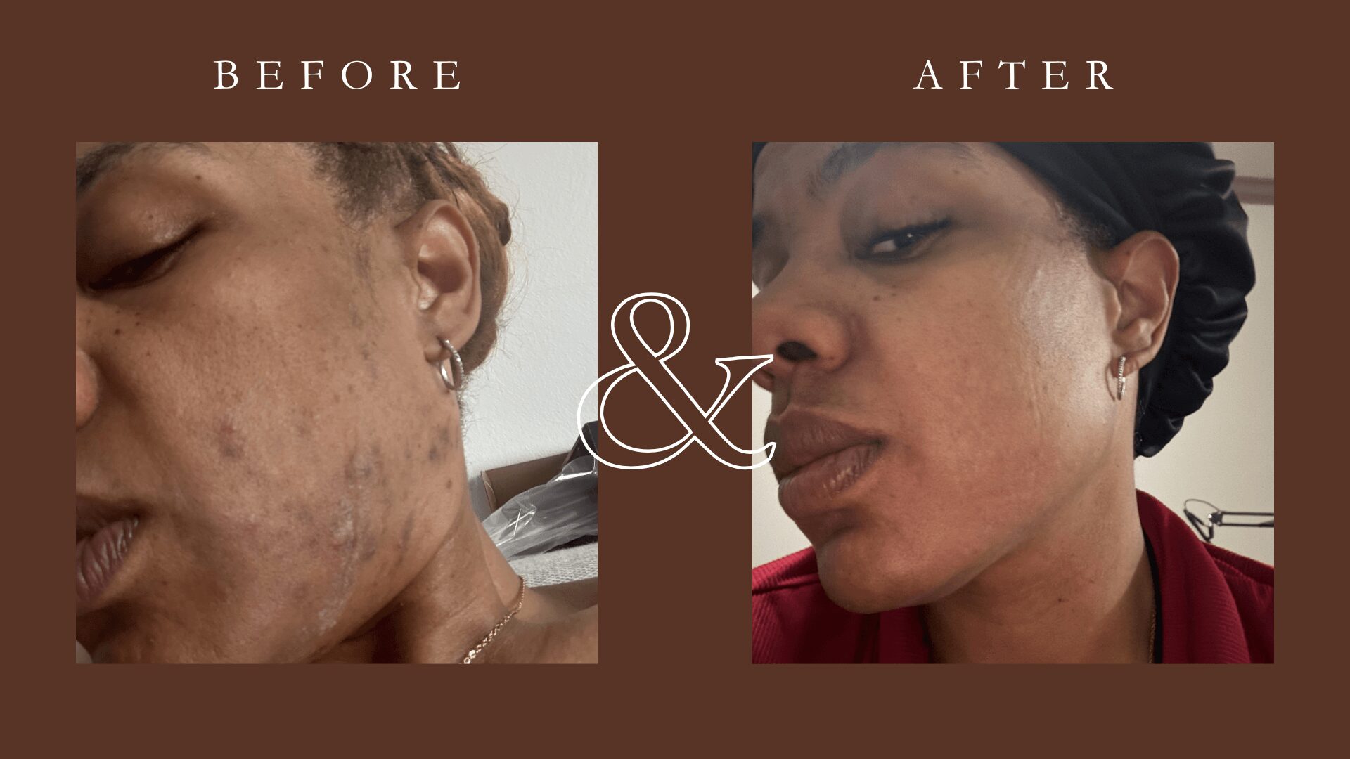 Side-by-side comparison of skin before and after treatment, showing improvement. Both images feature a woman with earrings, dark hair, and similar angles.