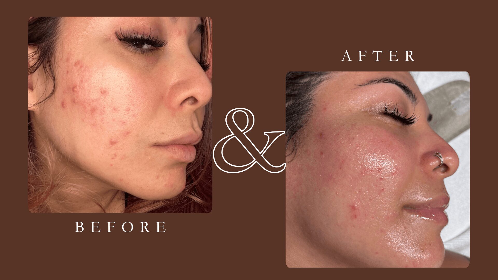 Side profile of a woman showing skin improvement with fewer acne scars after treatment.