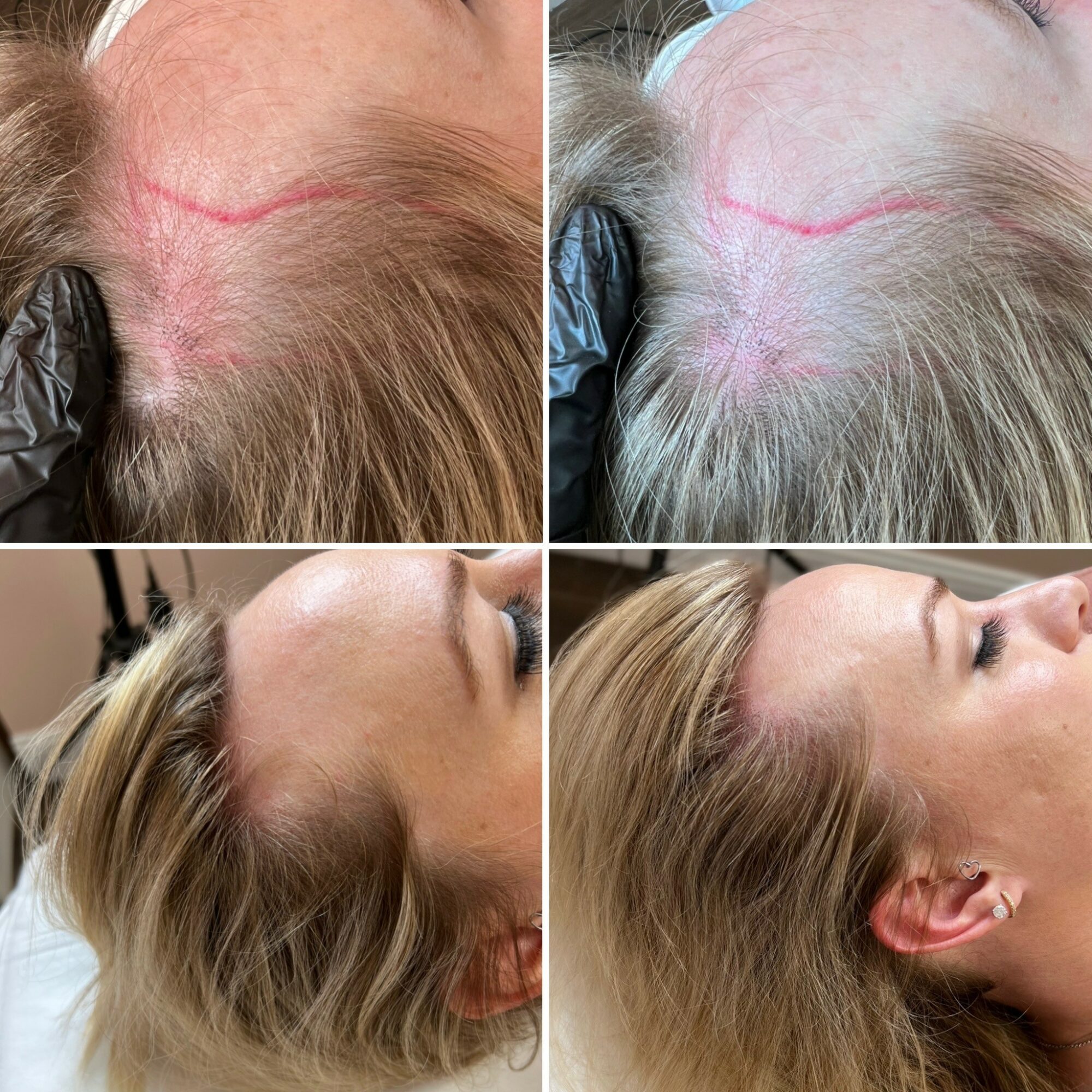 Before and after images of scalp treatment showing hair growth and healing, side views of a woman's head with blonde hair.