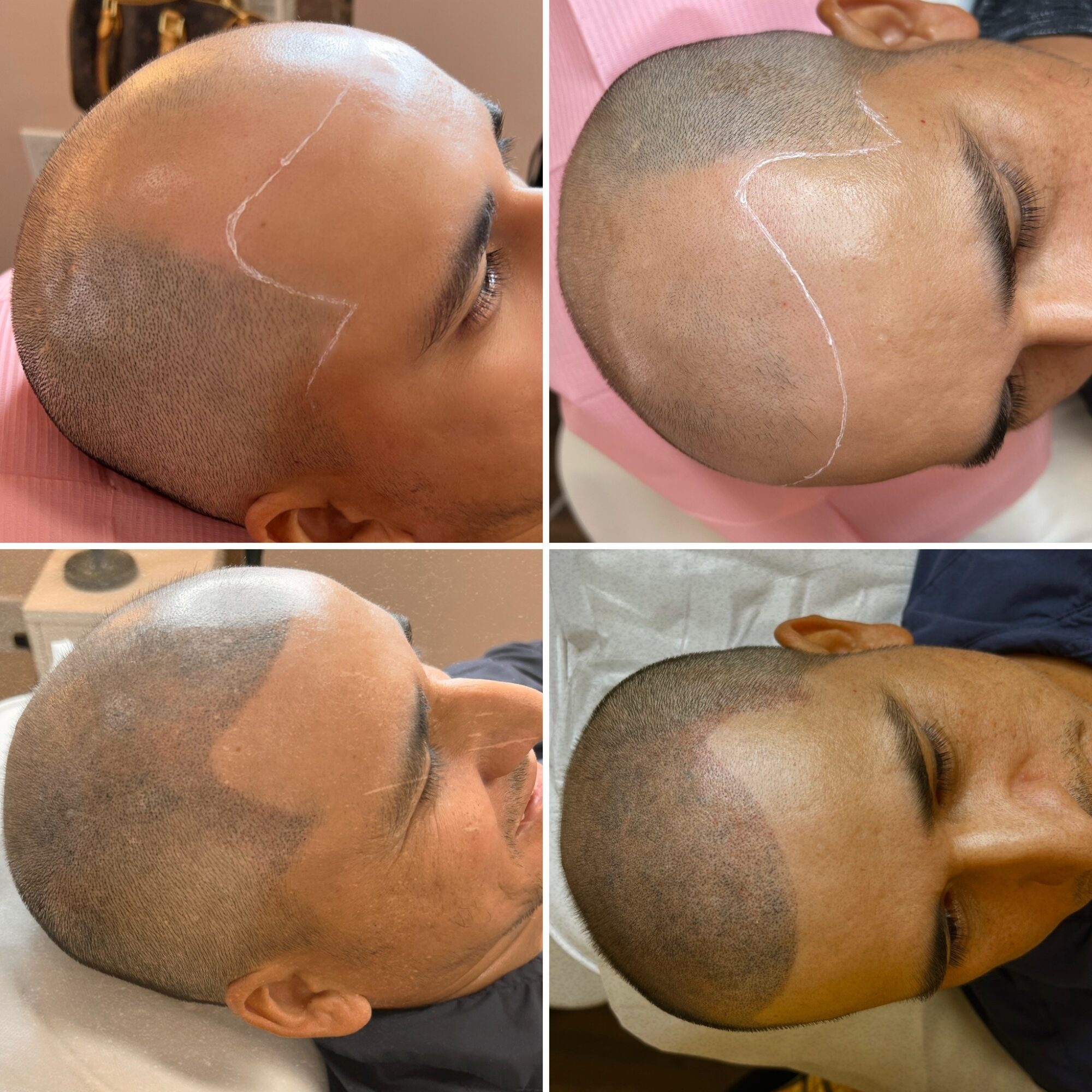 Four images showing different stages of scalp treatment, with shaved heads and markings on scalp, in clinical settings.