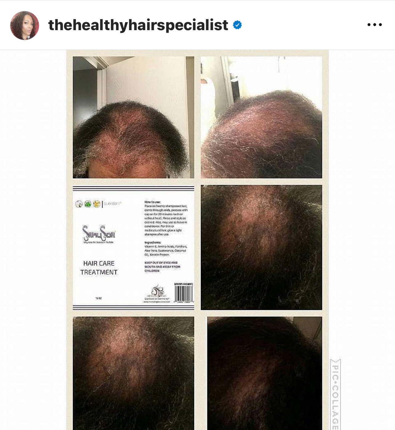 Six images showing a person's scalp before and after hair care treatment, focusing on hair thinning and regrowth areas.