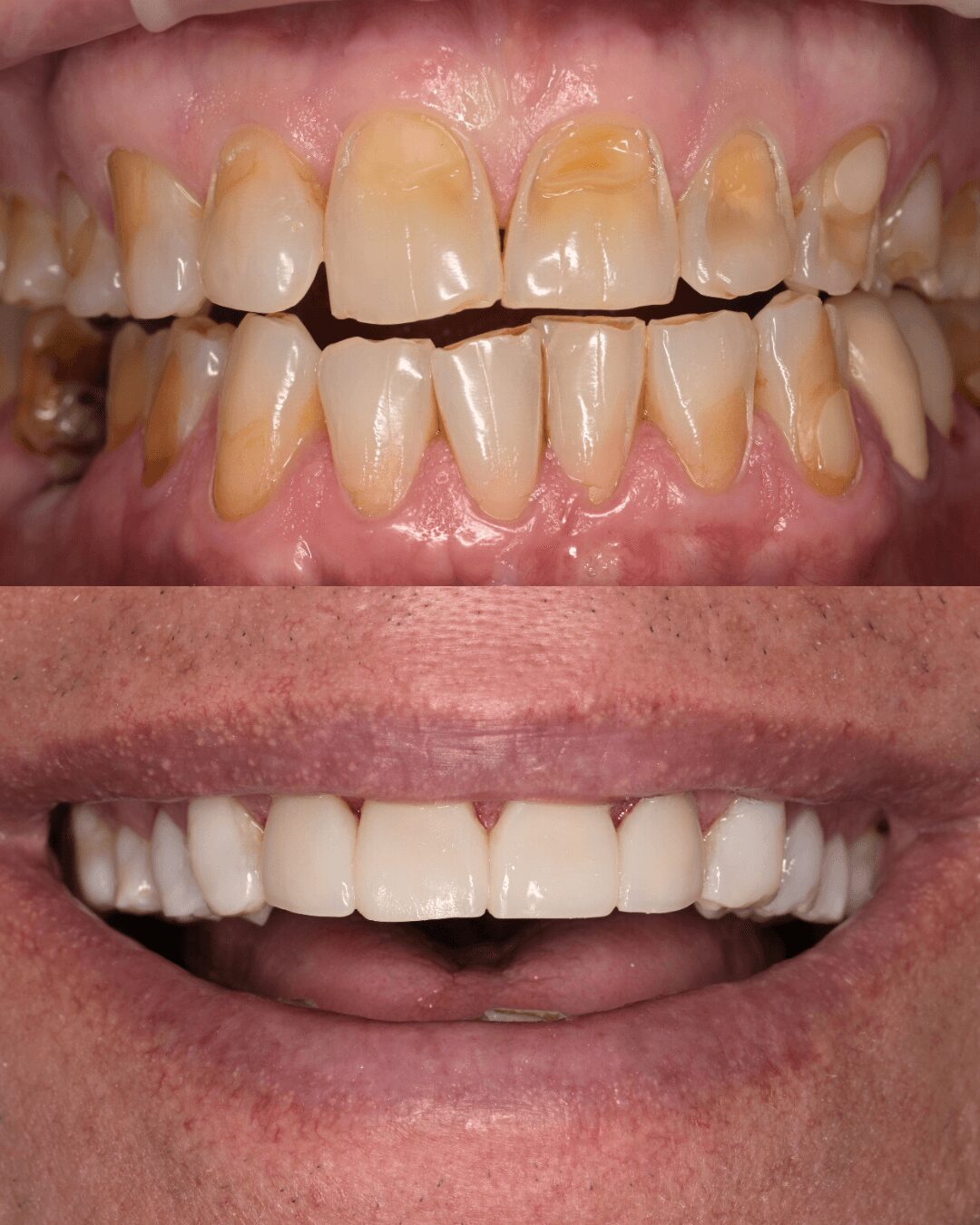 Comparison of teeth before and after dental treatment, showing improved alignment and whitening.