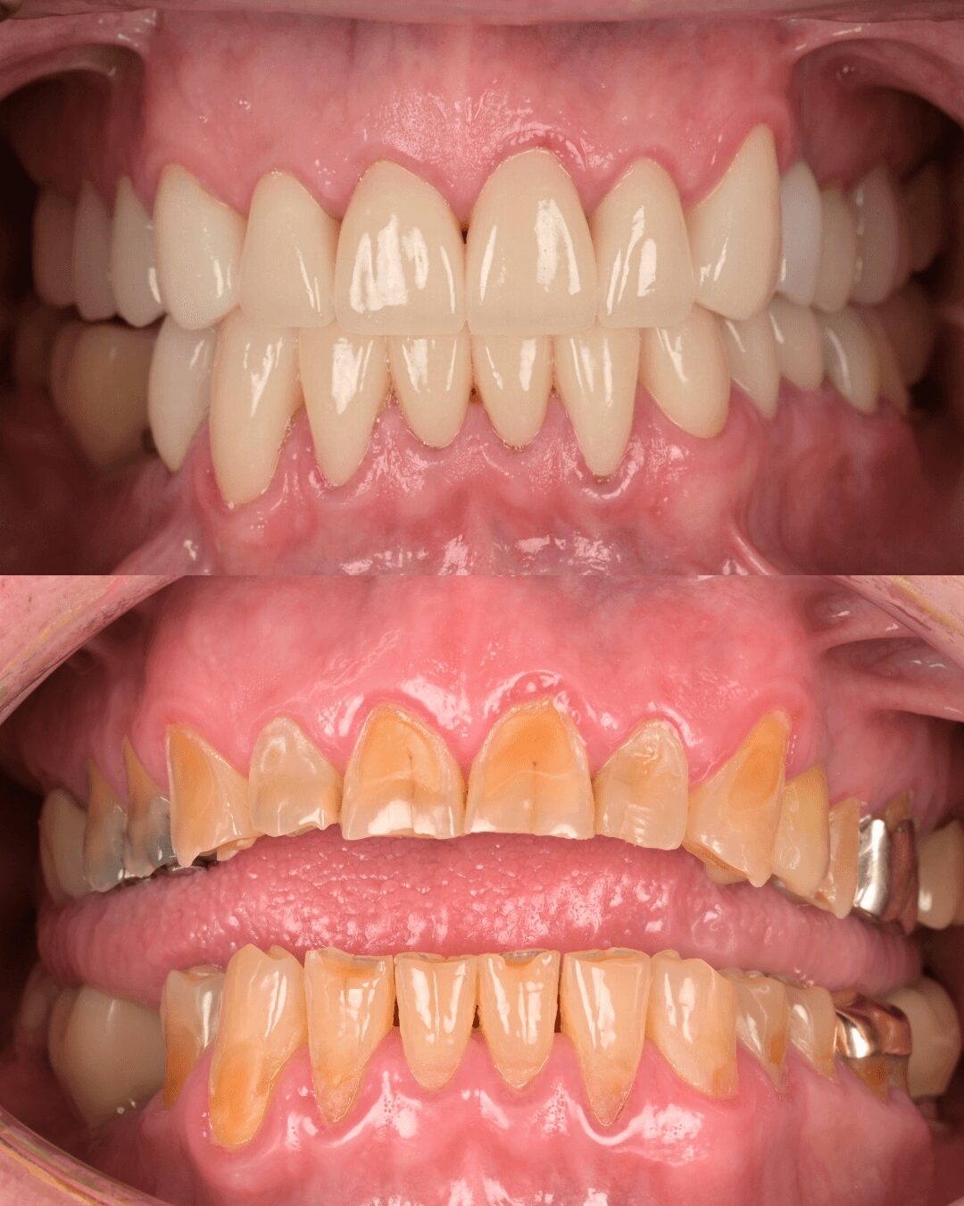 Close-up of teeth showing healthy upper teeth and lower teeth with significant plaque and tartar buildup.