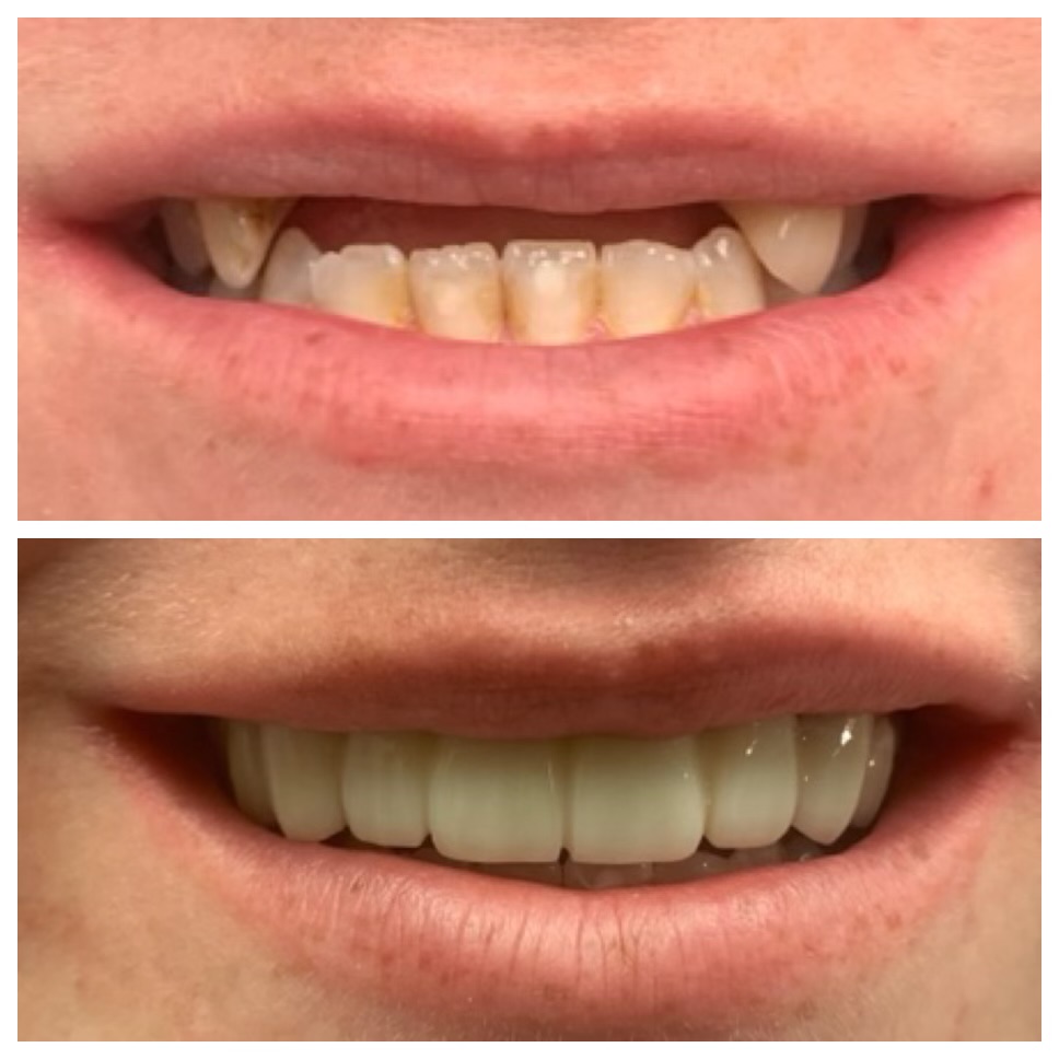 Close-up of a person's mouth showing before and after dental treatment, with improved, even teeth in the after image.
