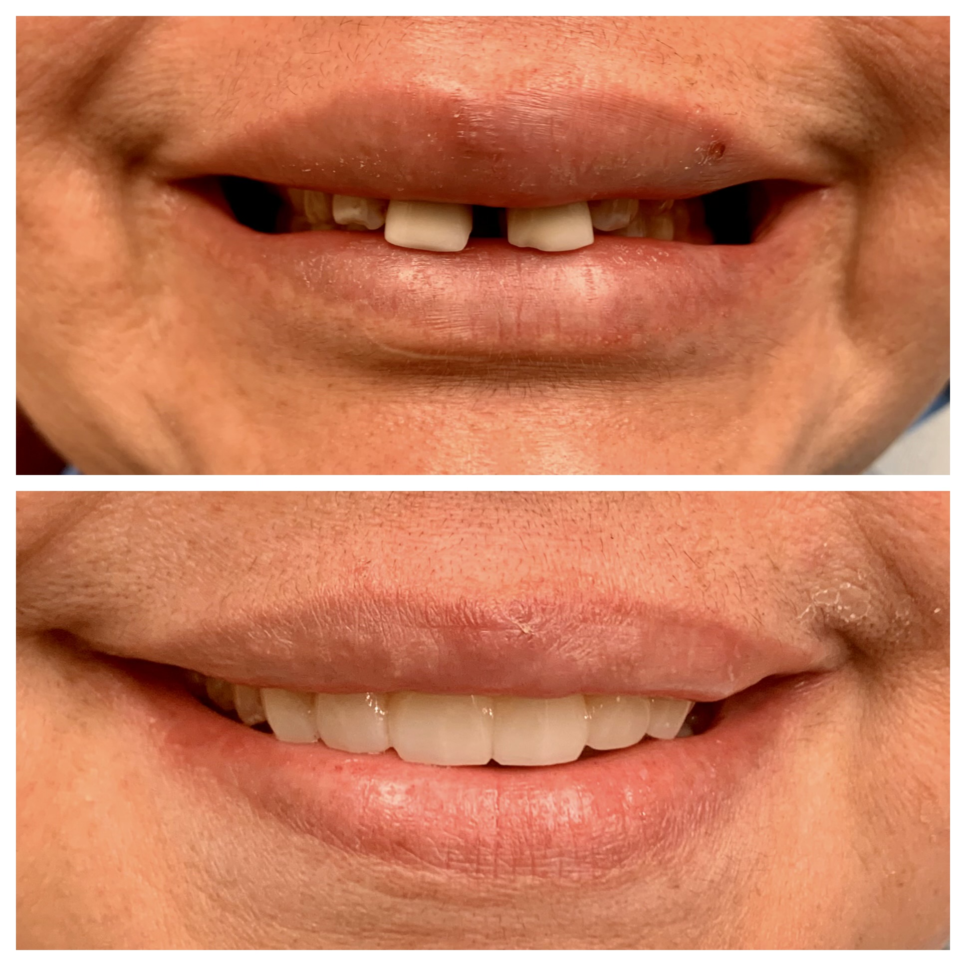 Close-up of a person's mouth showing missing and uneven teeth in the top image, and a full, even smile in the bottom image.