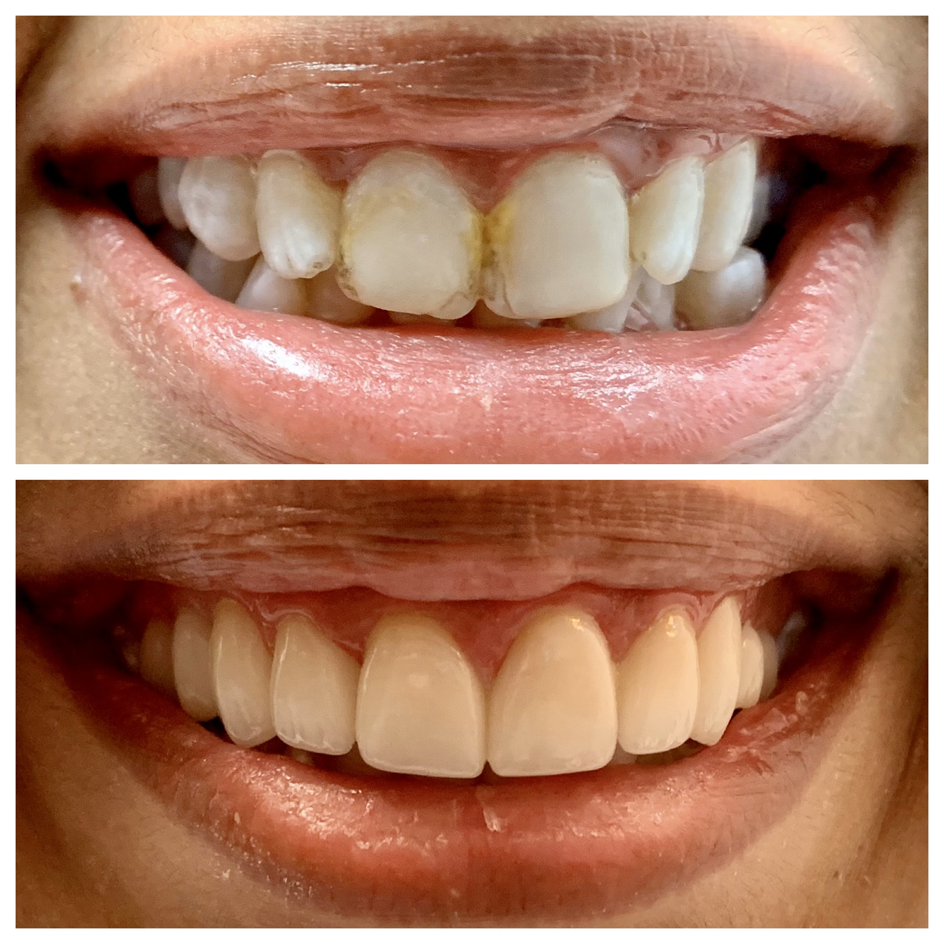 Comparison of teeth before and after dental treatment, showing improved alignment and cleanliness, with 20 words, confidence 0.95