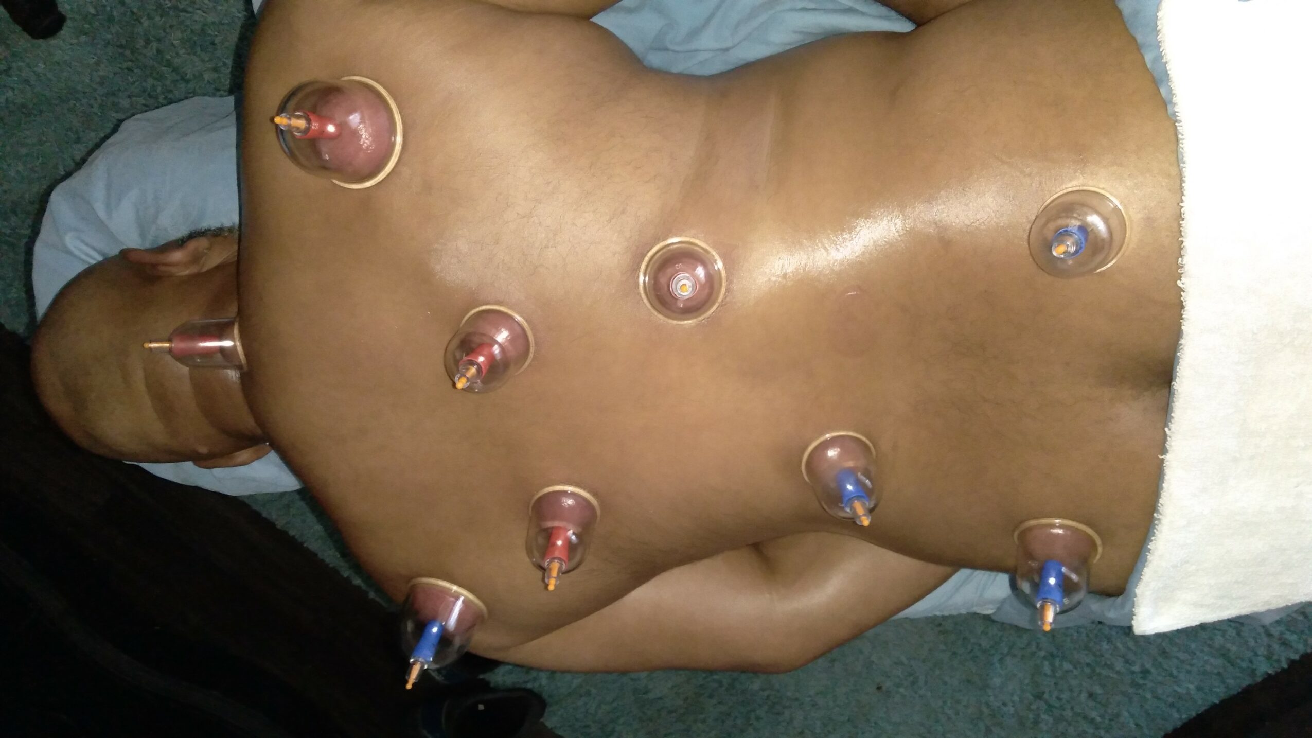 Back of a person with multiple small, round, transparent medical cups attached to skin, used for cupping therapy.