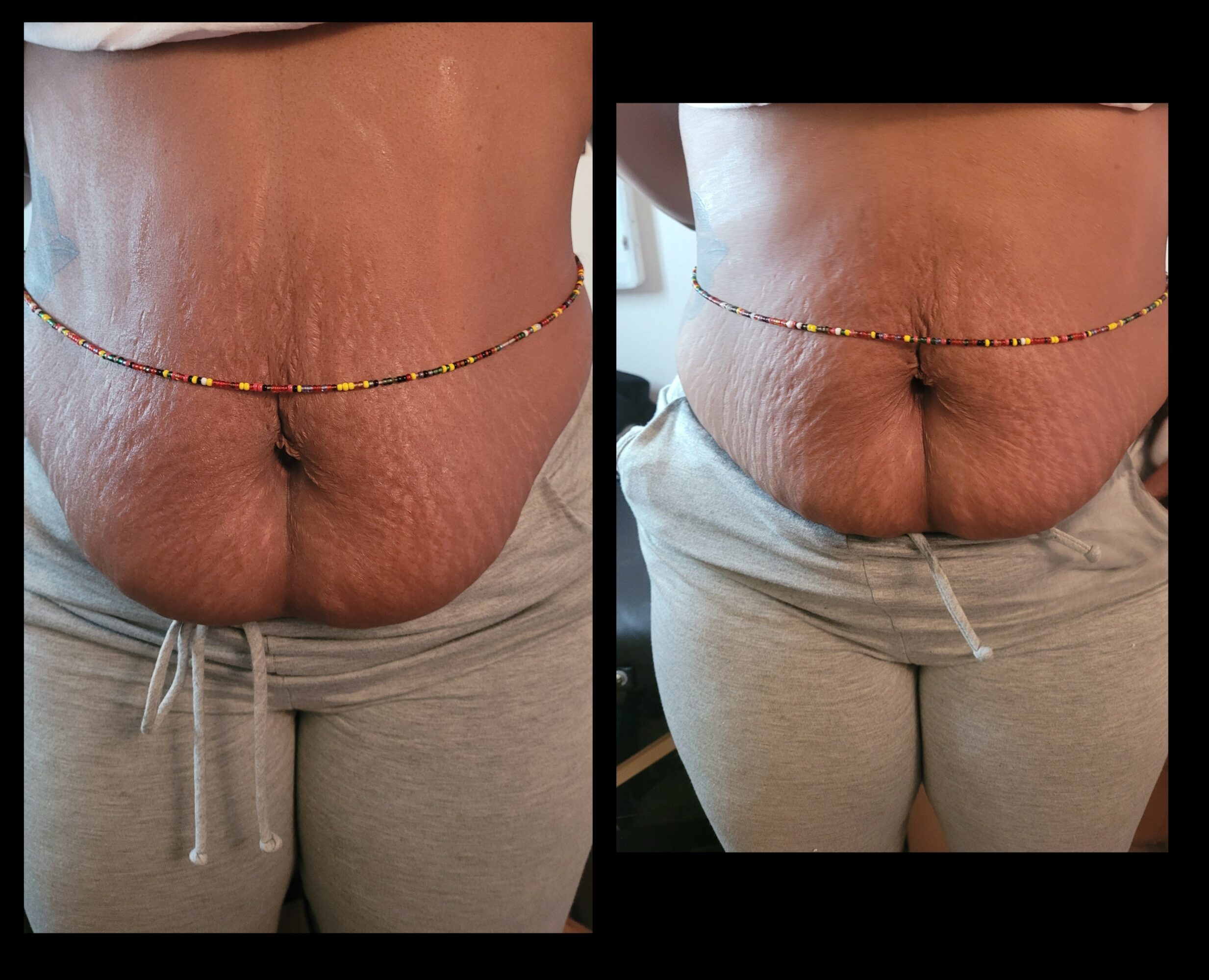 Close-up of a person's lower abdomen and hips, showing skin with wrinkles and a beaded waist chain, wearing gray sweatpants.