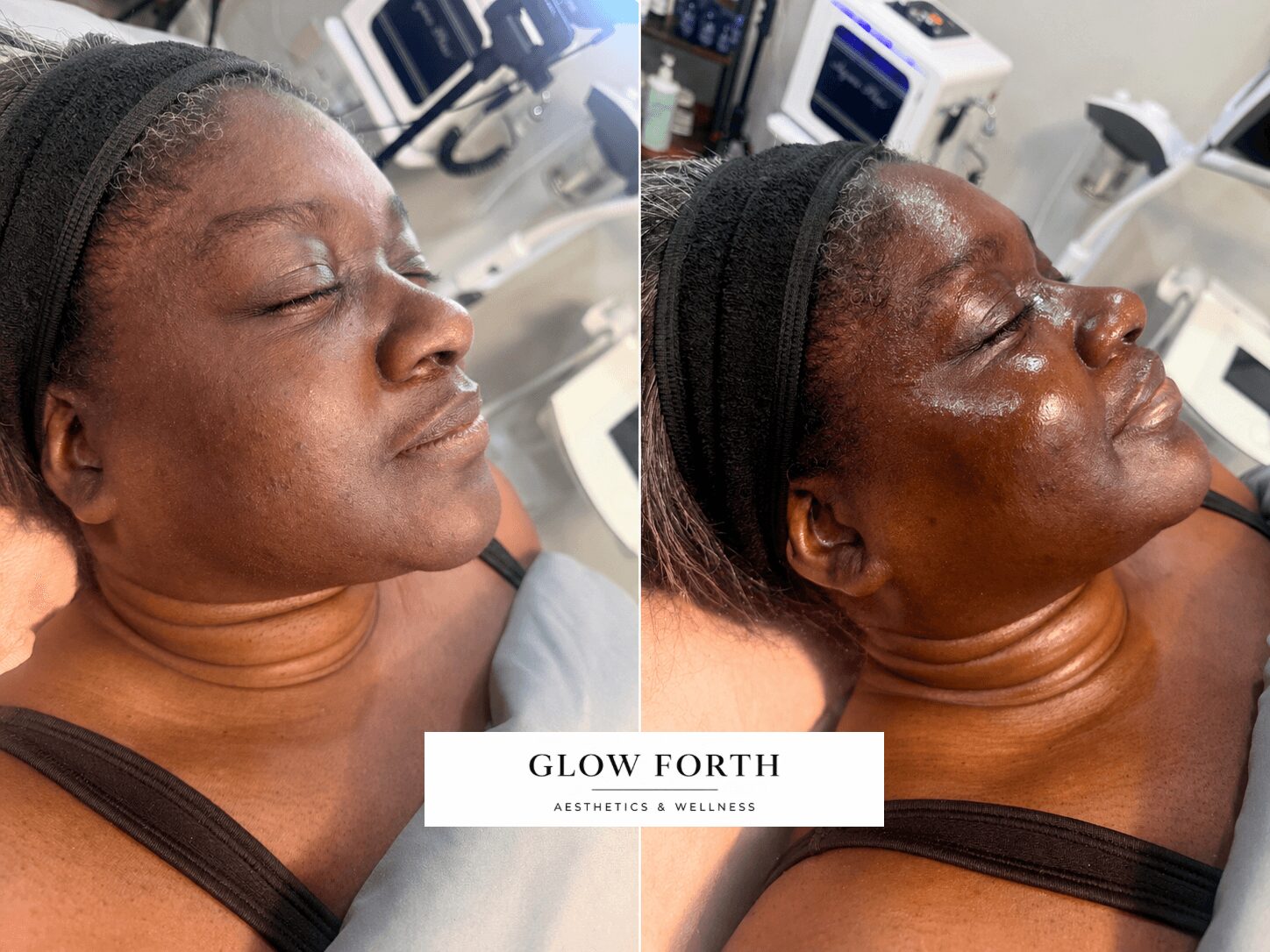 Side view of a woman with eyes closed, lying down, receiving a skincare treatment, with skincare equipment nearby.