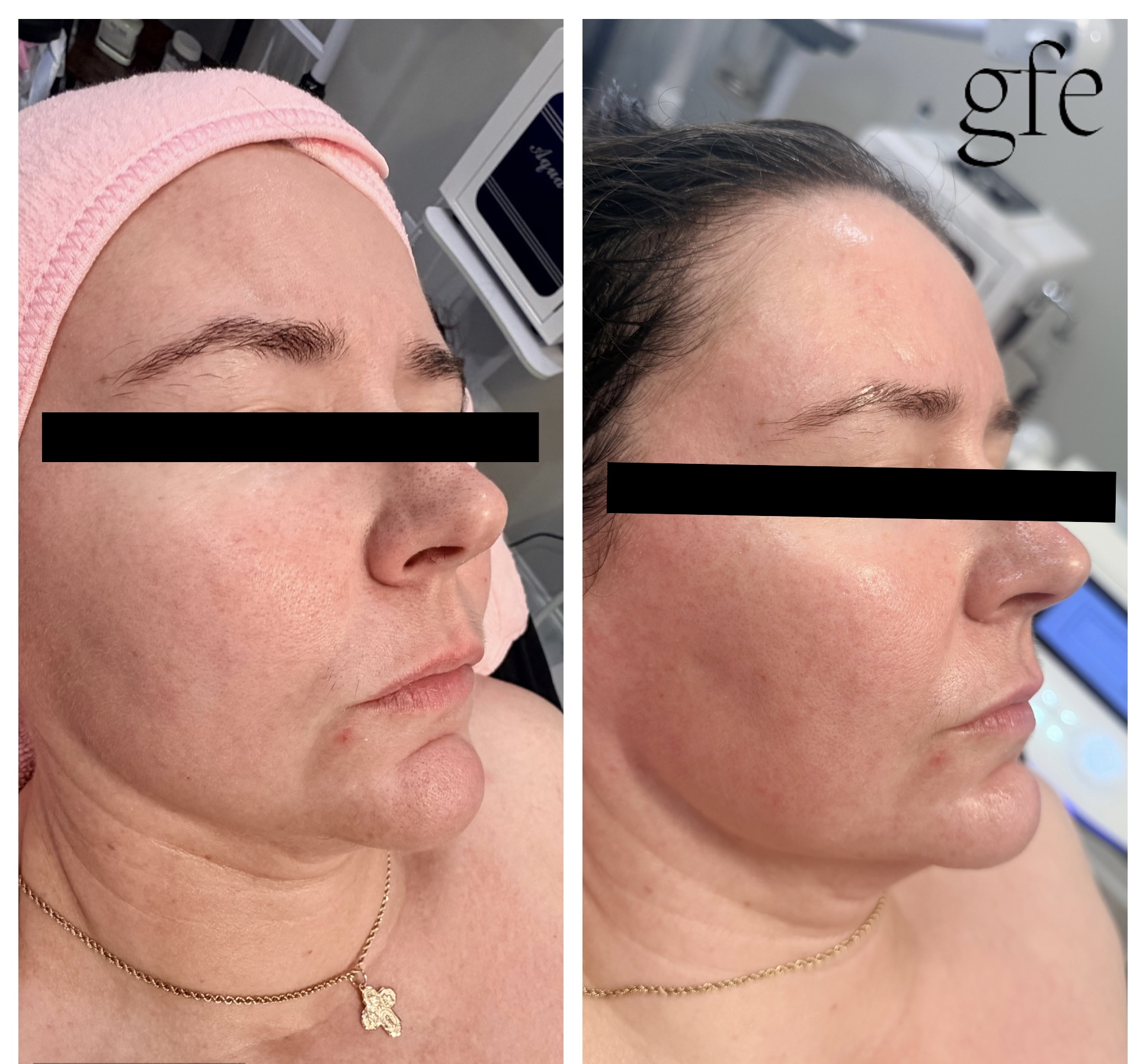 Side-by-side comparison of a woman's face before and after treatment, showing skin improvement, with black bars covering eyes, and a logo in the top right.