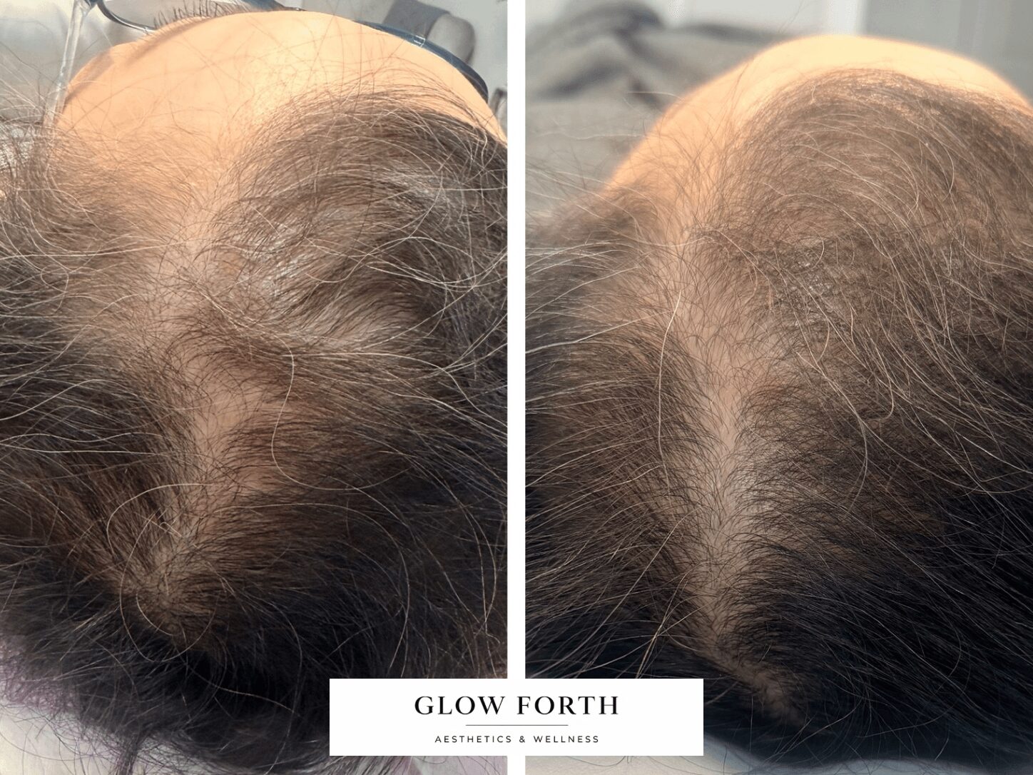Comparison of scalp showing hair thinning before and after treatment, with visible hair growth improvement.