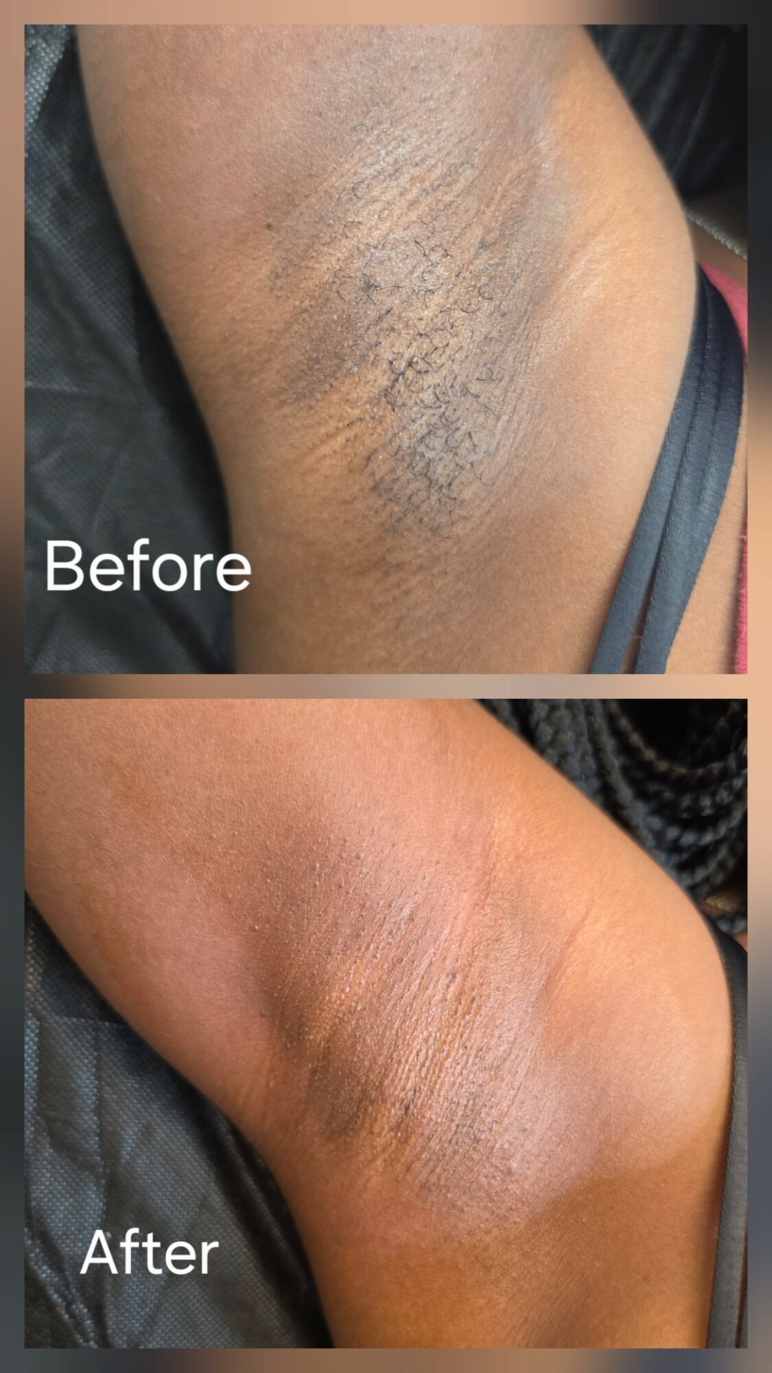 Close-up of a person's armpit showing skin improvement after treatment, with smoother skin and reduced dryness.